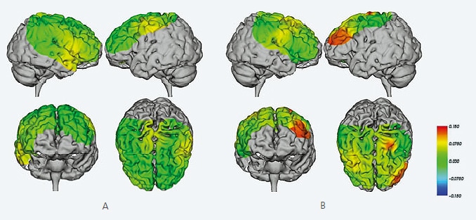 Brain Activity during Lower-Limb Locomotion (Walking on a Treadmill)