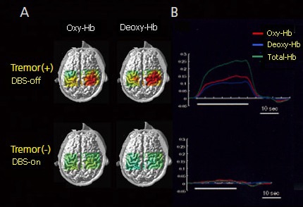 fNIRS Measurement of Change in Active Brain Oxygen Metabolites in Tremor Patient