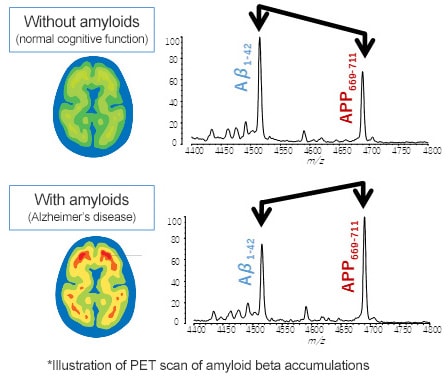 Illustration of PET scan of amyloid beta accumulations