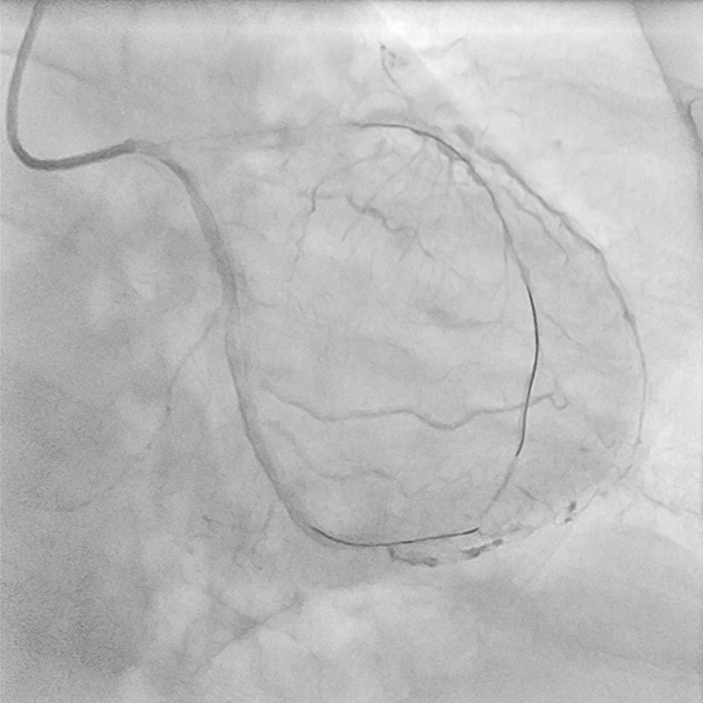 CTO Reverse Angiography