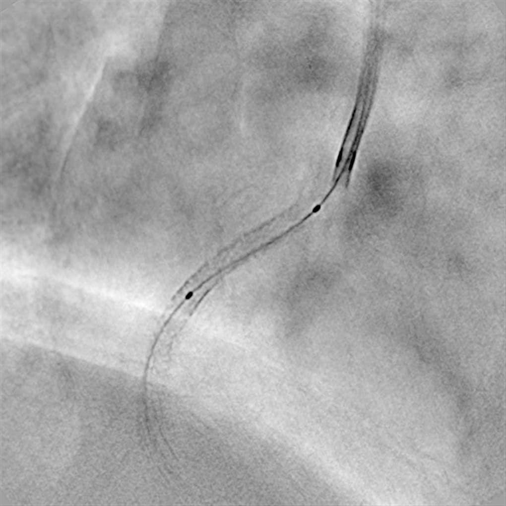 Stent Expansion Effect Confirmation