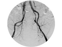 Angiography