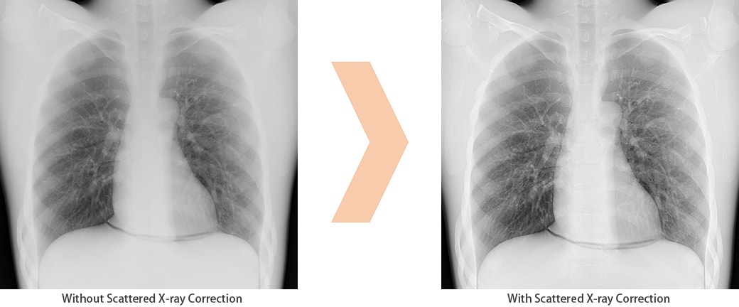 Scatter Correction Enables Grid-less Radiography 