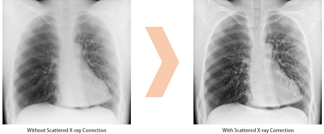 Scatter Correction Enables Grid-less Radiography 