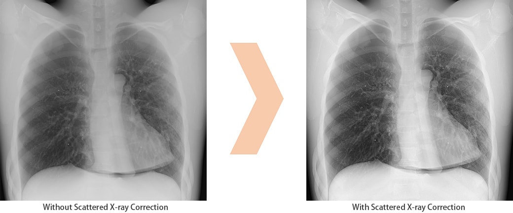 Scatter Correction Enables Grid-less Radiography 