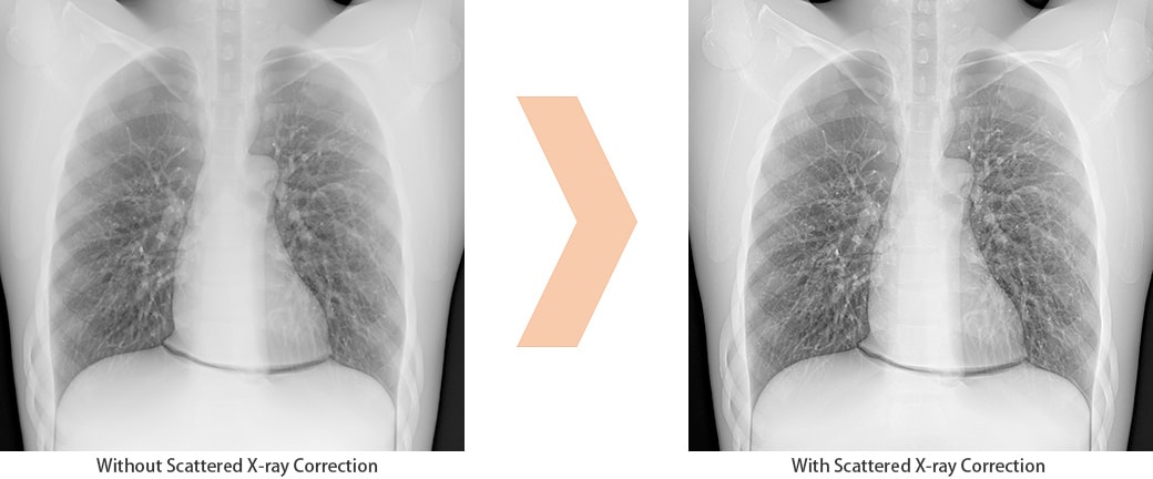 Scatter Correction Enables Grid-less Radiography 