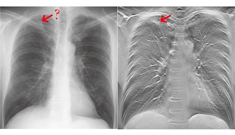 The image on the left shows a plain chest X-ray; the image on the right shows a chest image using tomosynthesis * The image on the right was taken using the SONIALVISION safire series.