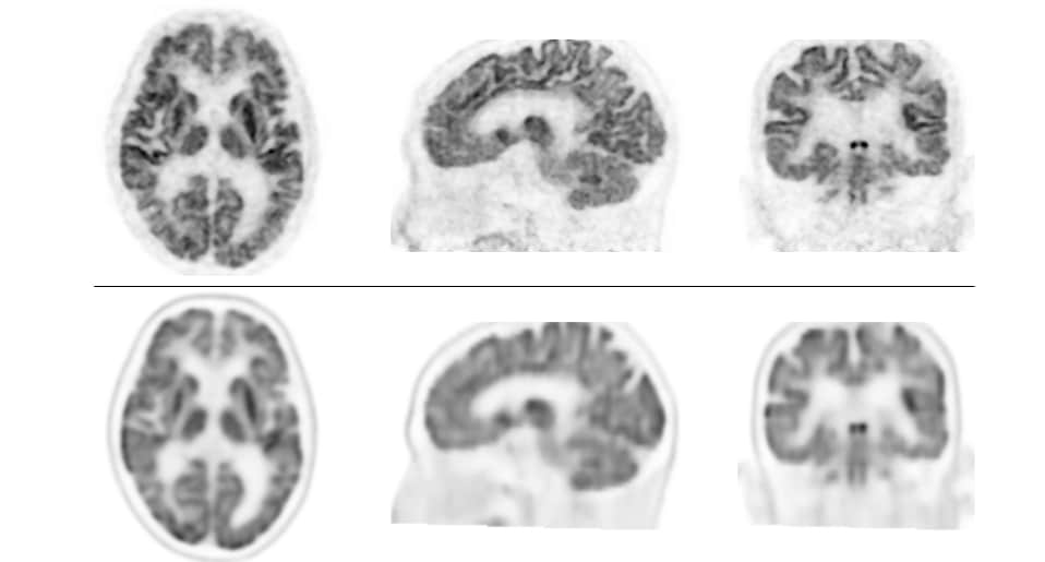 Arriba: Imágenes de FDG-PET cerebral obtenidas con el sistema TOF-PET BresTome Abajo: Imágenes de FDG-PET cerebral obtenidas con el sistema convencional Las imágenes superiores aparecen con mayor resolución y muestran mayor detalle. Las imágenes inferiores aparecen algo borrosas.